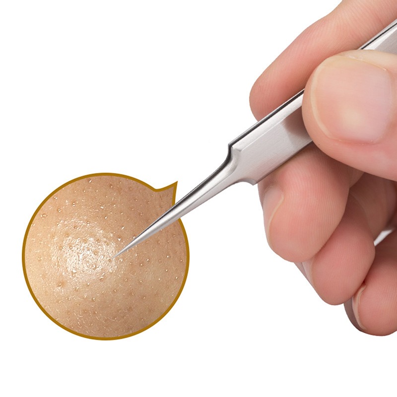 ملقط احترافي فائق الدقة لإزالة - مراجعة Luxury Skincare Acne وسعره